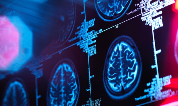 Il cervello delle donne? 4 anni più giovane!