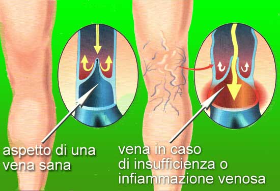 L'aspetto delle vene quando sono sane ed in caso di infiammazione / insufficienza venosa